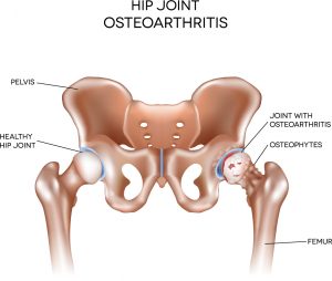 hip joint osteoarthritis and healthy hip joint