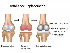 total knee replacement illustration